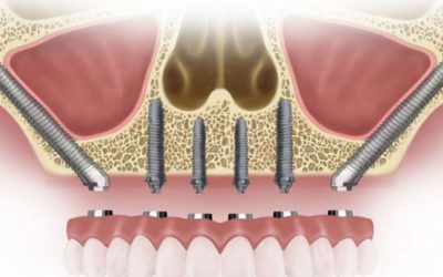 A New Type of Dental Implant