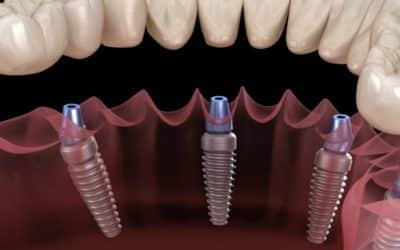 What Are All-on-4® Dental Implants?