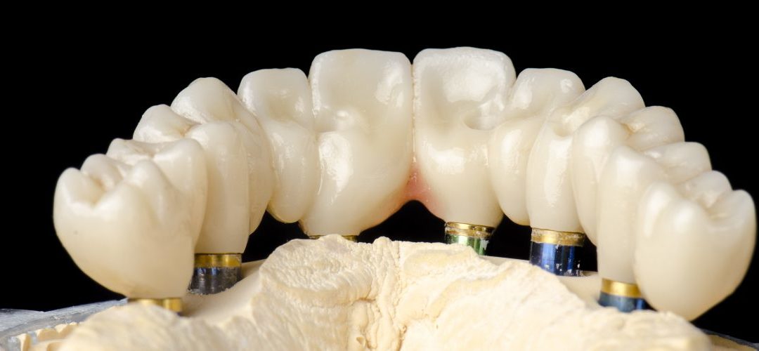 The Top 3 Benefits of Full Arch Implants
