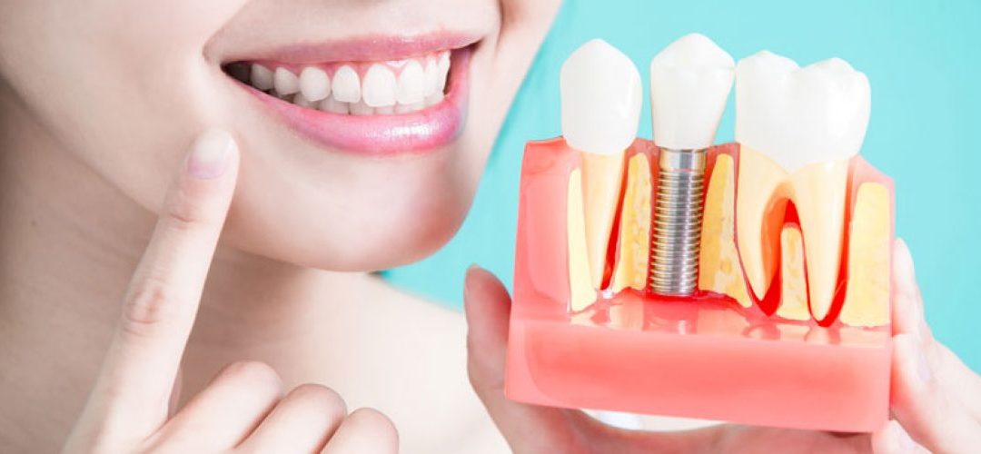 The Cosmetic Benefits Of Dental Implants