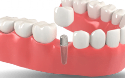 Dental Implants: Osseointegration and Titanium Posts