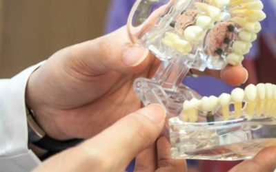 How Dental Implant Solve the Issue of Unstable Dentures