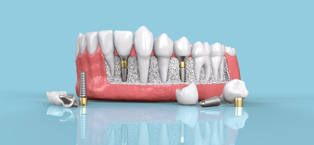 How 3D Imaging Enhances Dental Implant Treatment