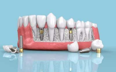 How 3D Imaging Enhances Dental Implant Treatment