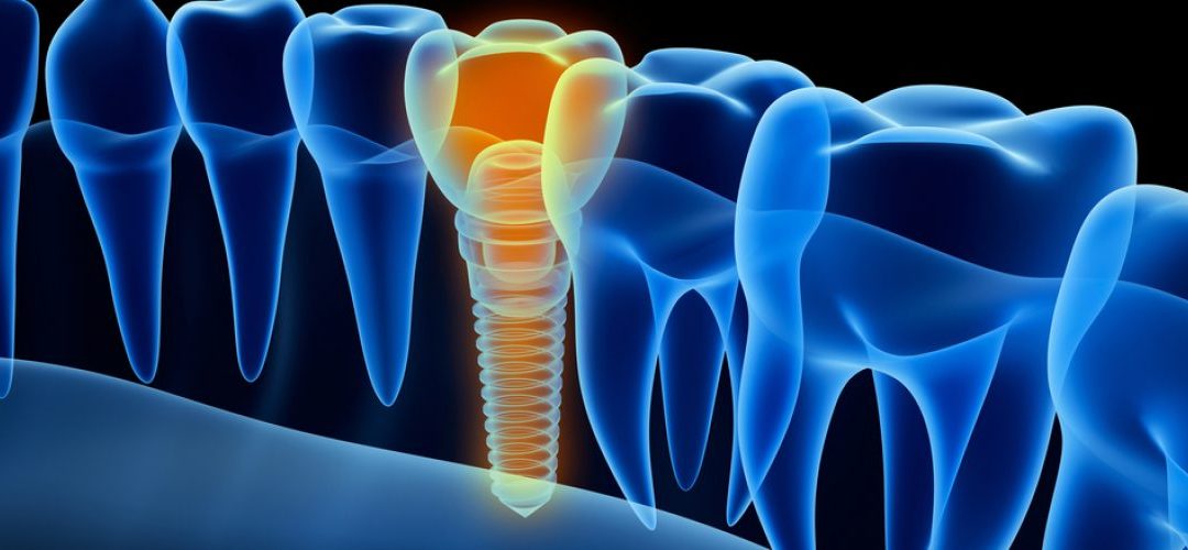What Type of Dentist Should I See for Dental Implants?