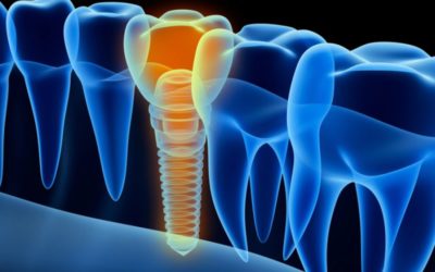 4 Reasons to Choose Dental Implants Over Dentures