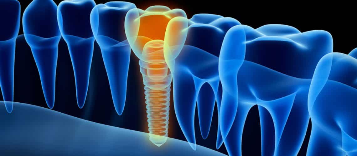 What Type of Dentist Should I See for Dental Implants? - The Marquis Center  for Dental Implants