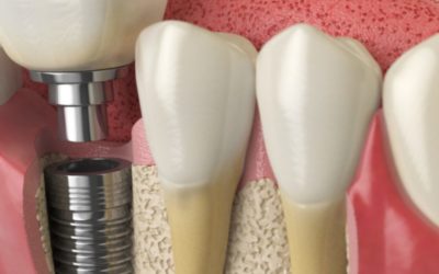 The Most Important Questions to Ask Before Getting Dental Implants