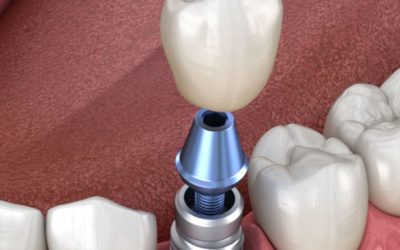 Dental Implants This Holiday Season