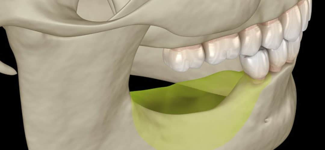I Have Bone Loss, Can I Get Dental Implants?